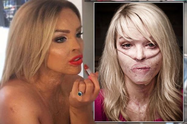 What Happened To Katie Piper's Face?