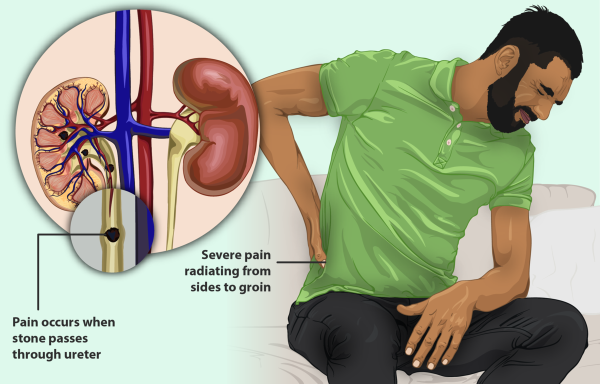 Does Lack Of Enzymes Causes Kidney Stones? Symptoms, Prevention And Causes Explored