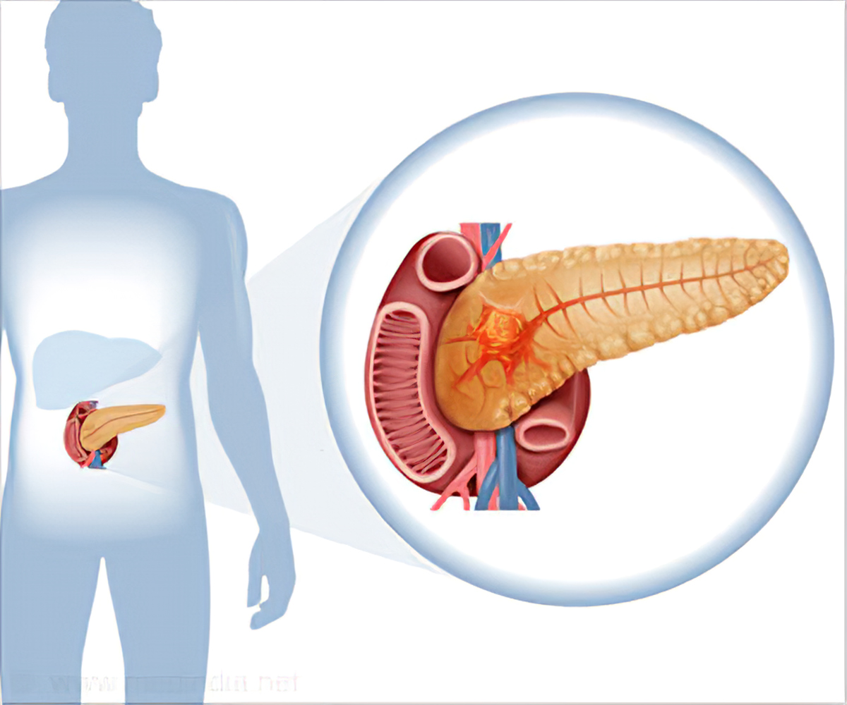 What Are The Pancreatic Cancer Symptoms That Should Not Be Ignored? What You Should Know