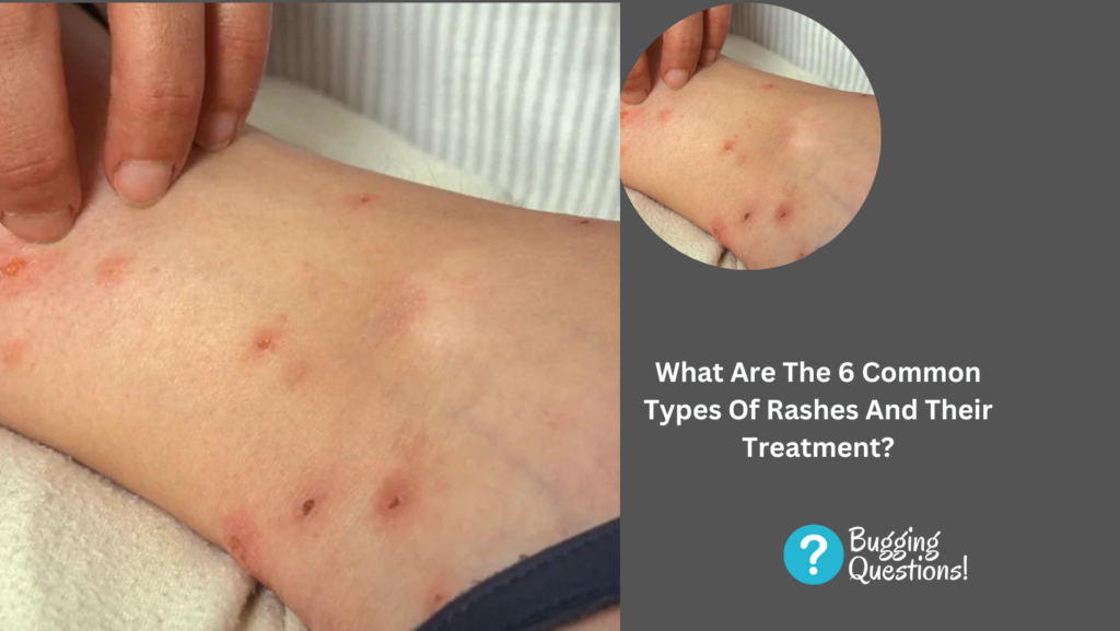 What Are The 6 Common Types Of Rashes And Their Treatment? Here Is What ...