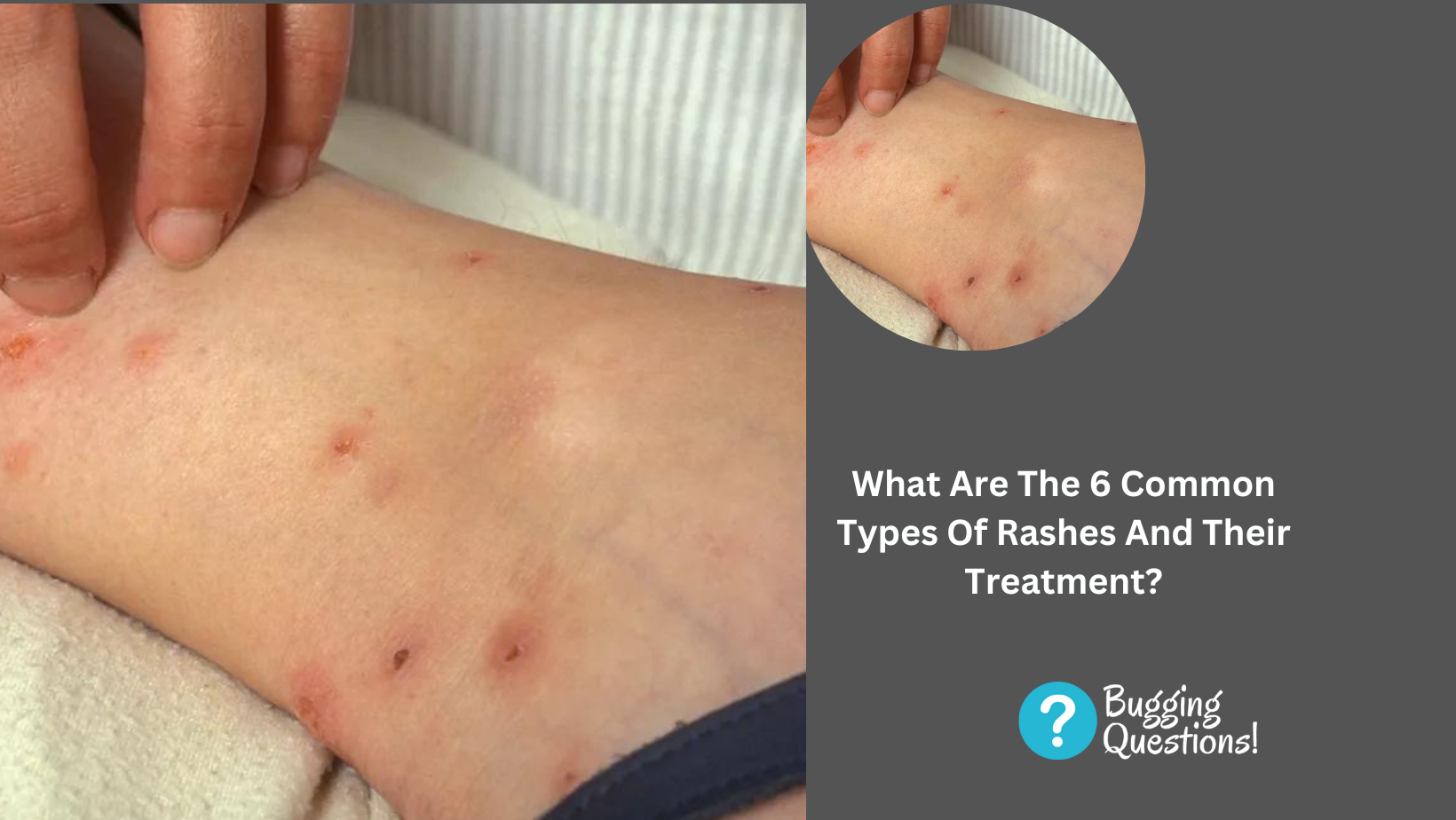 What Are The 6 Common Types Of Rashes And Their Treatment?