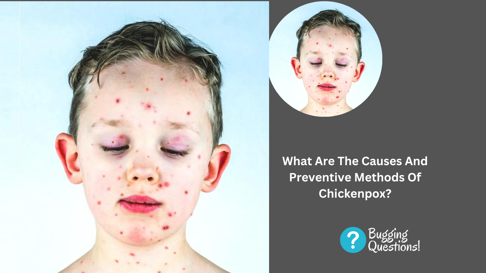 What Are The Causes And Preventive Methods Of Chickenpox?