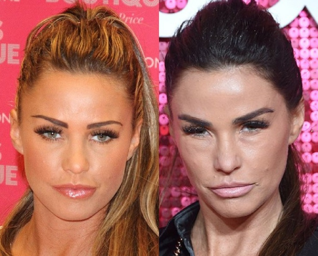 What Happened To Katie Price Lips Did She Do Plastic Surgery? Before