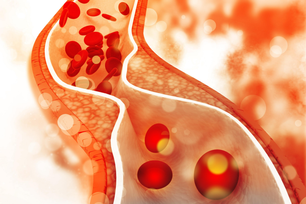 What Are The Causes And Prevention Of High Cholesterol Levels?