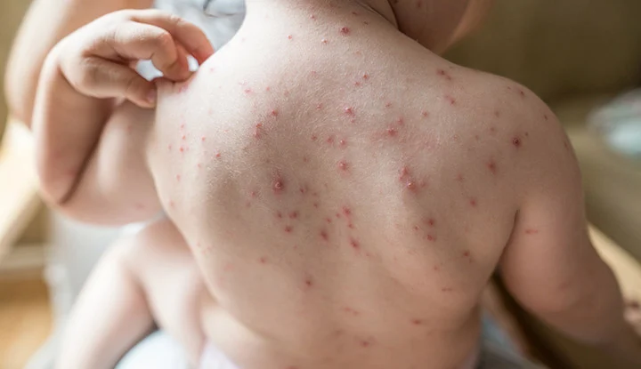 What Are The Causes And Preventive Methods Of Chickenpox?