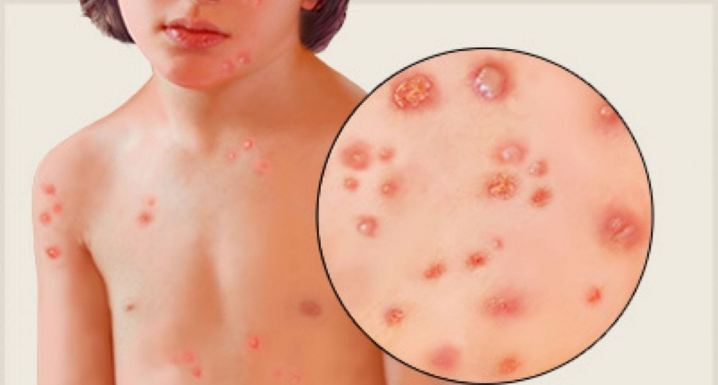 What Are The Causes And Preventive Methods Of Chickenpox?